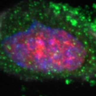 Découverte d’un marqueur de susceptibilité au cancer gastrique 